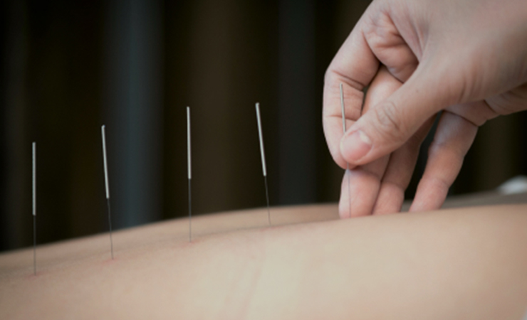 Acupuncture Treatment, Stabilization Training, Acupuncture Services,
